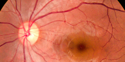 Silmän sisäinen verisuonisto
