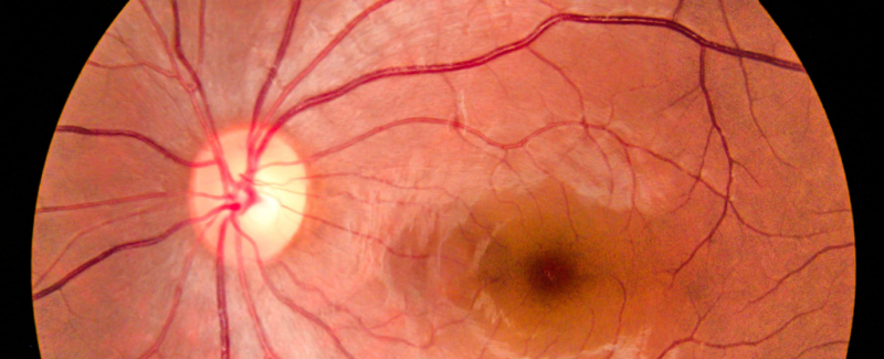 Effekterna av det allmänna hälsotillståndet på ögonens hälsa